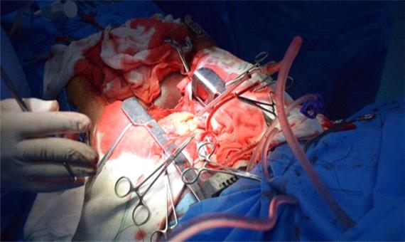 نیمه دوم امسال تاکنون 56 عمل جراحی قلب باز در سنندج انجام شده است